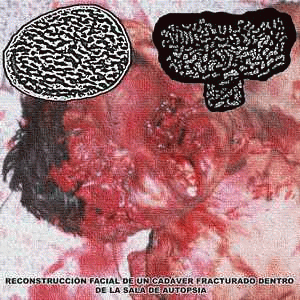 Carcinoma Basocelular : Reconstrucción Facial de un Cadáver Fracturado Dentro de la Sala de Autopsia Carcinoma Basocelular : Reconstrucción Facial de un Cadáver Fracturado Dentro de la Sala de Autopsia